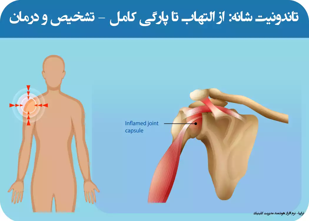 تاندونیت عضلات شانه