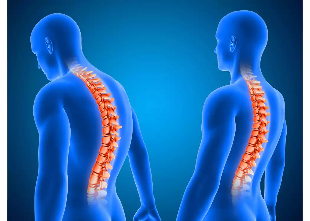 دو علت شایع کمردرد: اسپوندیلوز و لیزخوردگی مهره